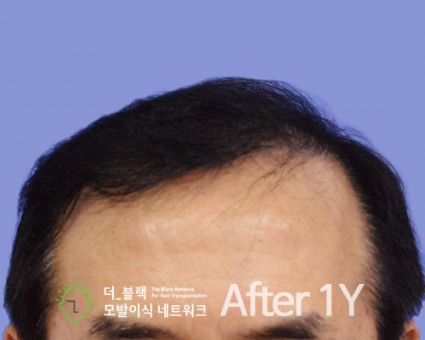 전두부 전체 After (시술 후)