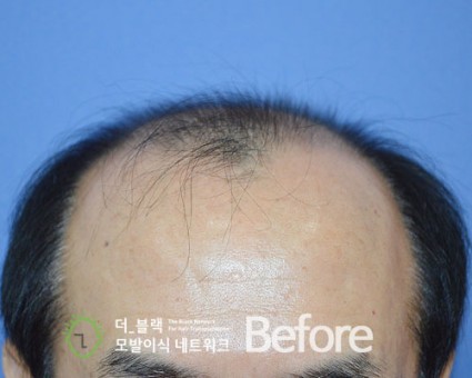 전두부 전체 Before (시술 전)