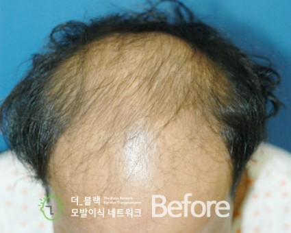 전두부 전체 Before (시술 전)