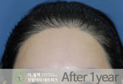 헤어라인(넓고 높은 이마라인 교정) After (시술 후)
