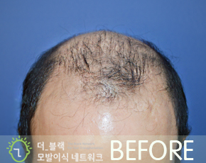 남성 M자 탈모 Before (시술 전)