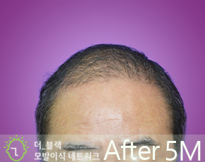 남성 정수리 After (시술 후)