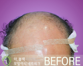 남성 정수리 Before (시술 전)