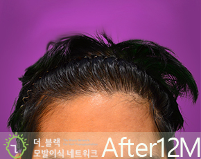 남성 가르마 After (시술 후)