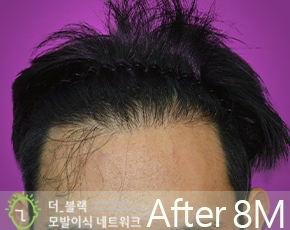 남성 M자 탈모 After (시술 후)