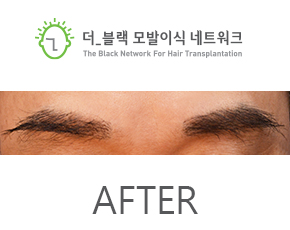 남자 눈썹 After (시술 후)