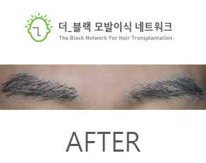 남자 눈썹 After (시술 후)