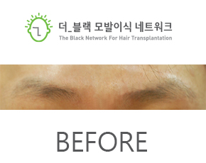 남자 눈썹 Before (시술 전)