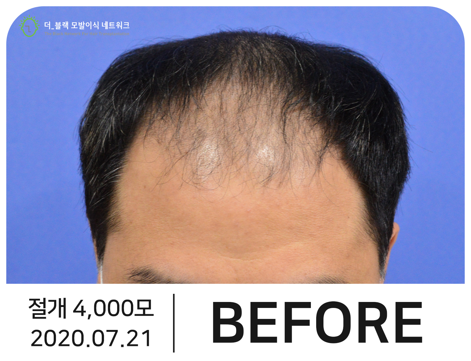 남자 M자, 정수리 탈모 Before (시술 전)