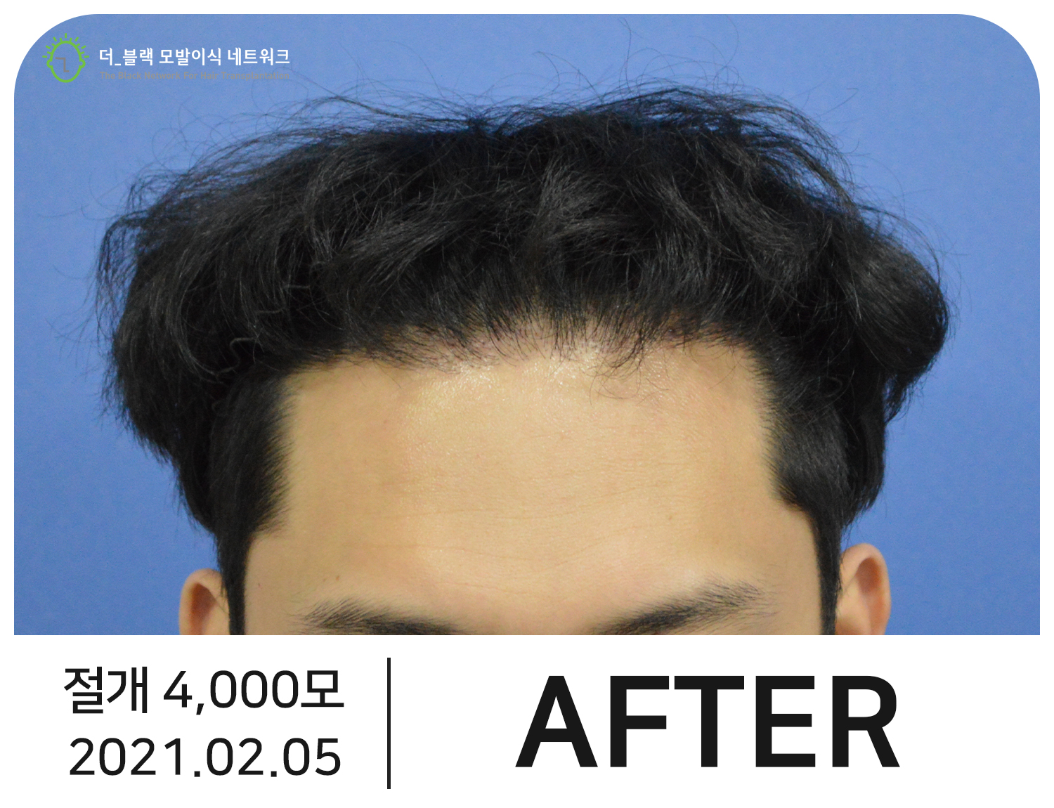 남자 M자 탈모 After (시술 후)