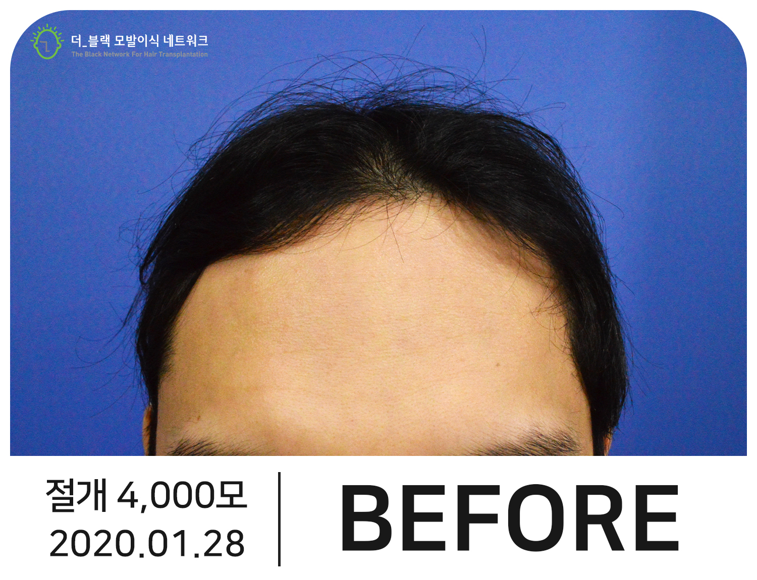 남자 M자 탈모 Before (시술 전)