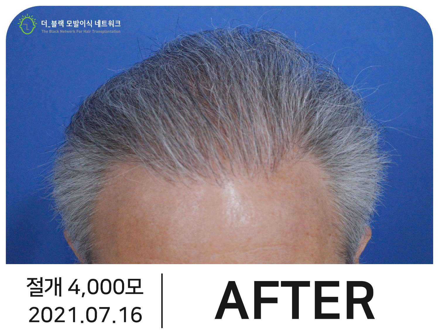 남자 M자, 정수리 탈모 After (시술 후)