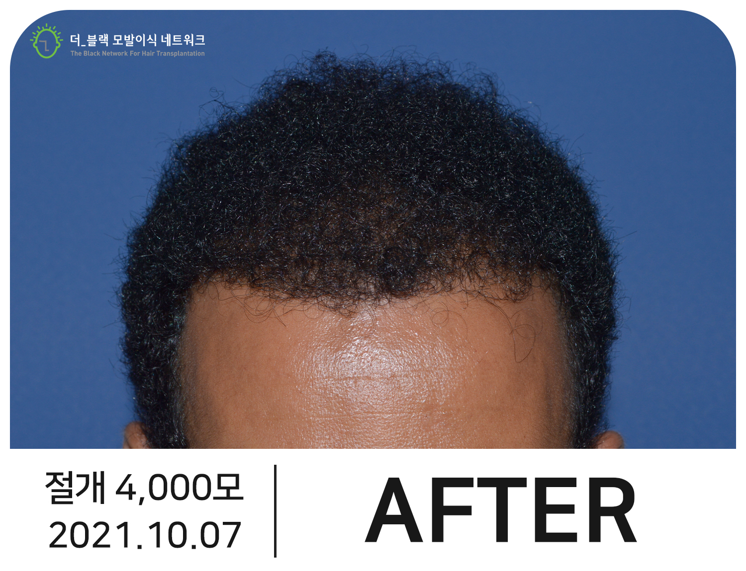 남자 M자, 정수리 탈모 After (시술 후)