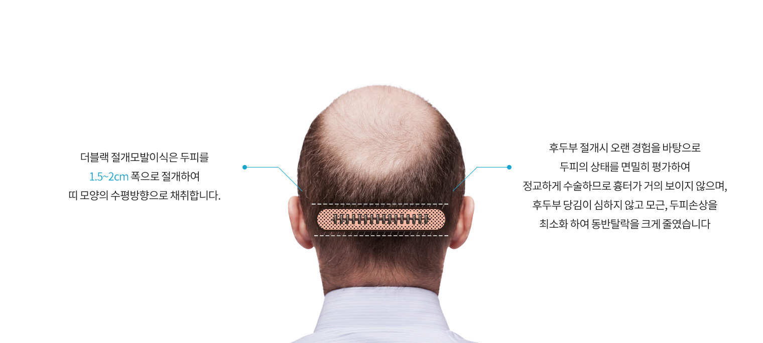 더블랙 절개모발이식