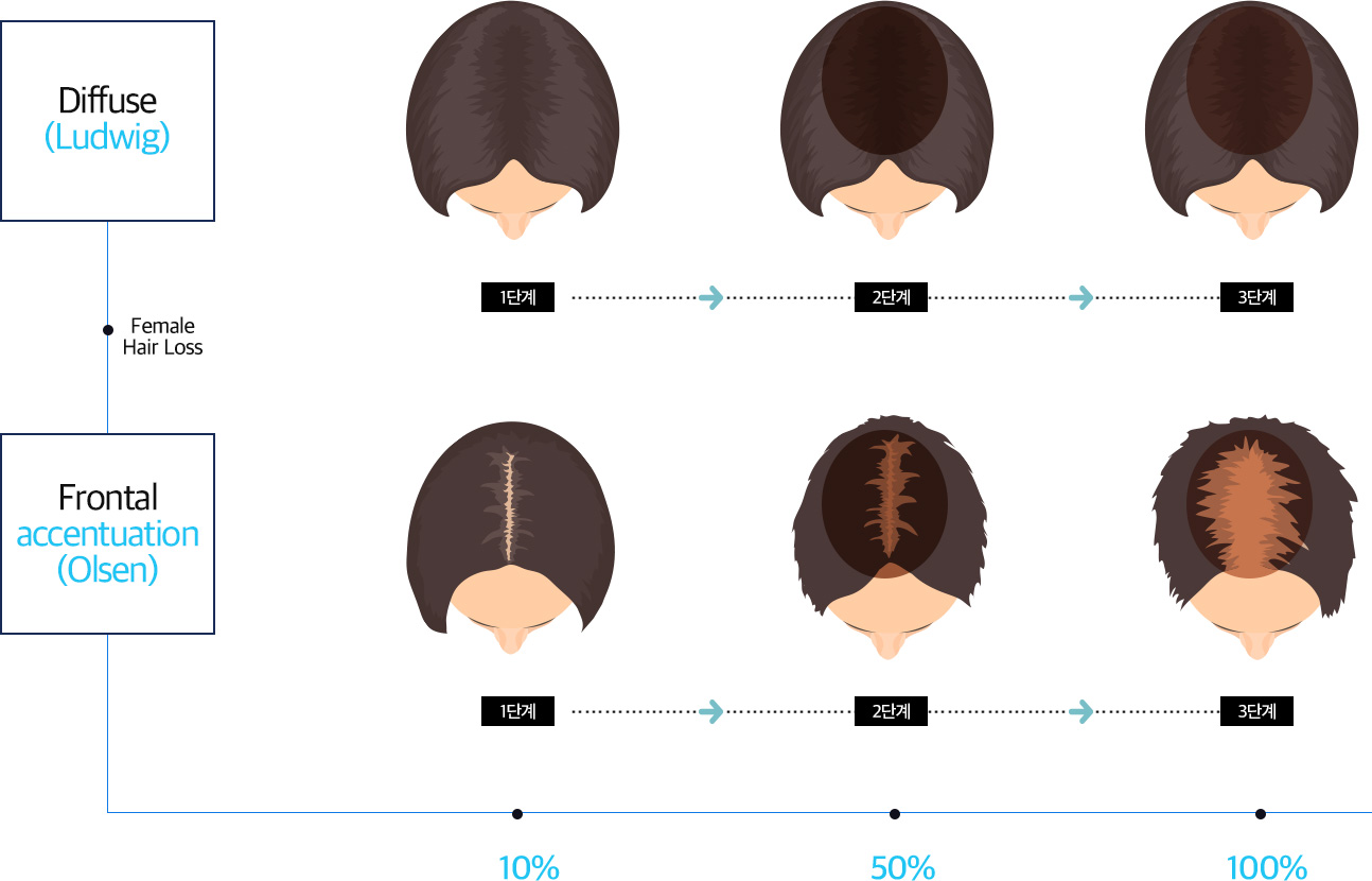 대한민국 여성 탈모의 표준 진행과정