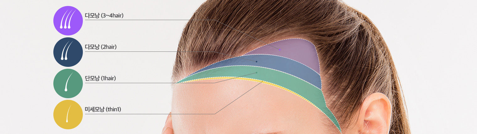 모발 굵기에 따른 4단계 그라데이션 이식