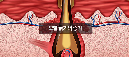 모발 굵기의 증가